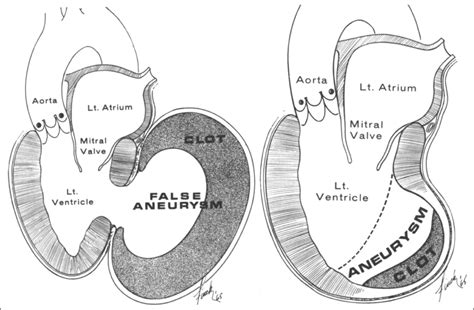 pseudoaneurysm vs true aneurysm echo.